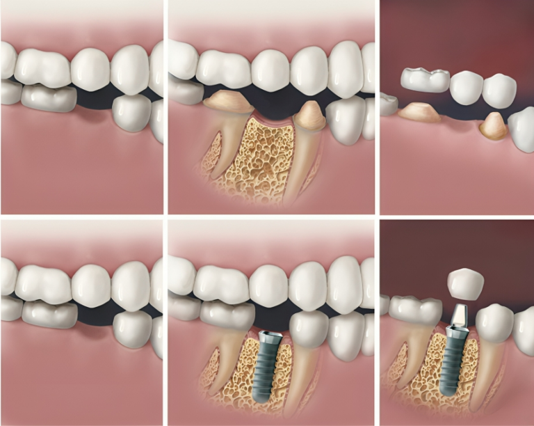 Reclaiming Your Smile: Exploring the Options for Teeth Replacement.