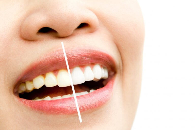 The Ultimate Guide to Professional Teeth Whitening Methods.