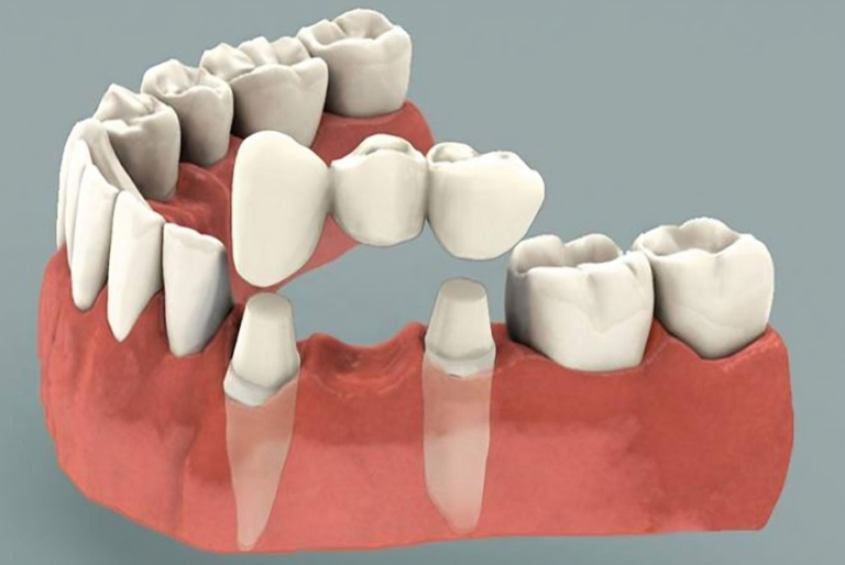 Maintaining Your Crown and Bridge: A Complete Guide.