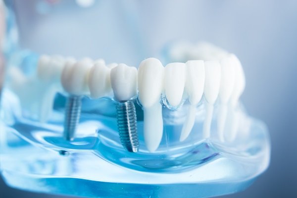 Teeth Replacement Solutions in Sector 2B