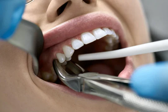 Best Surgical Tooth Extraction in Vaishali