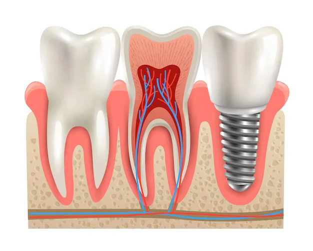 Best Dental Implant in Vaishali