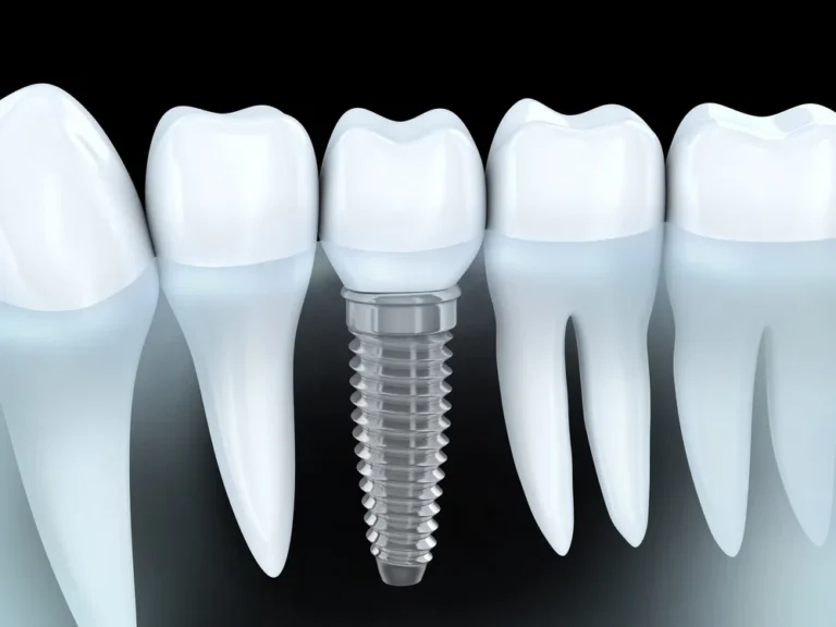 Best Teeth Replacement in Ghaziabad