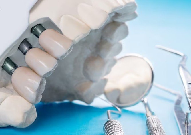 Best Teeth Replacement Centre in Vasundhara