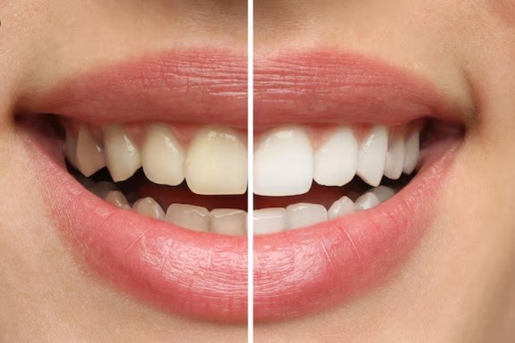 Best Teeth Whitening service in Ghaziabad