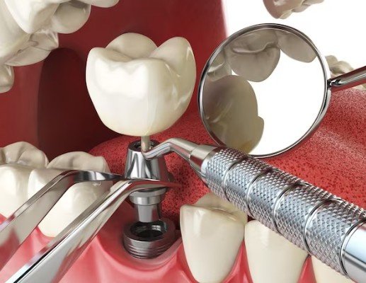 Dental implant procedure at the Best Dental Implantation Centre in Ghaziabad