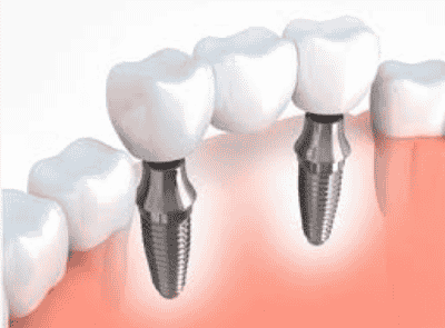 Teeth Replacement Center in Sector 3 Vasundhara