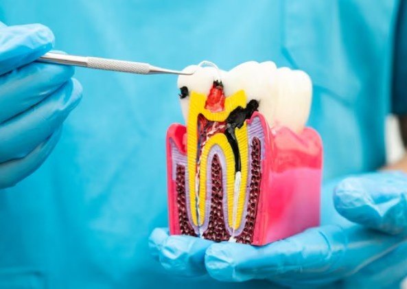 Root Canal Treatment in Sector 1, Vasundhara